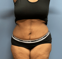 Tummy Tuck