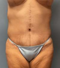 Tummy Tuck