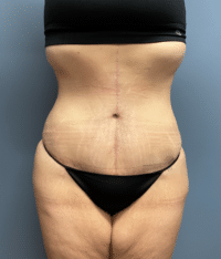 Tummy Tuck