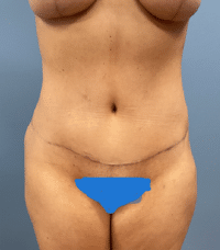 Tummy Tuck