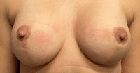 Nipple Repair/Reconstruction
