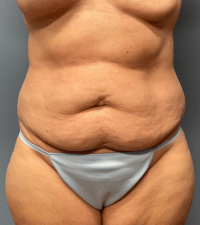 Tummy Tuck