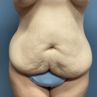 Tummy Tuck