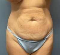 Tummy Tuck