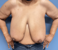 Breast Reduction