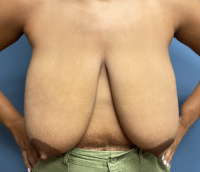 Breast Reduction