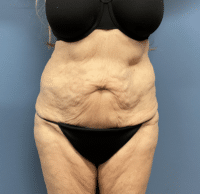 Circumferential Body Lift