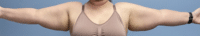 Arm Lift