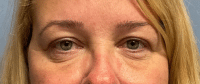 Eyelid Surgery