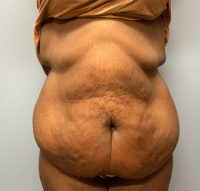 Panniculectomy