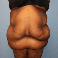 Panniculectomy