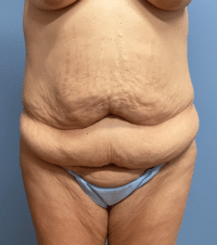 Tummy Tuck