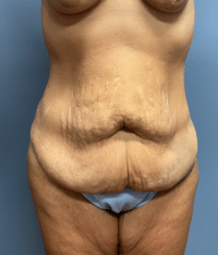 Tummy Tuck