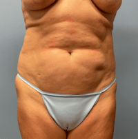 Tummy Tuck