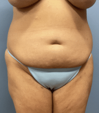 Tummy Tuck