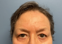 Brow Lift