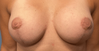 Nipple Repair/Reconstruction