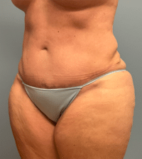 Tummy Tuck