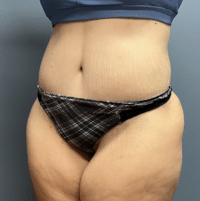Tummy Tuck