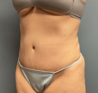 Tummy Tuck