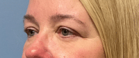 Eyelid Surgery