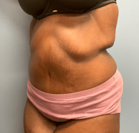 Panniculectomy
