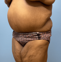Panniculectomy