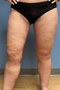 Thigh Lift