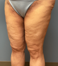 Thigh Lift
