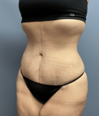 Tummy Tuck