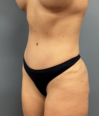 Tummy Tuck
