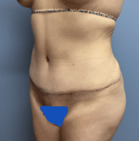 Tummy Tuck