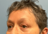 Brow Lift