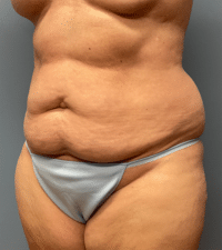 Tummy Tuck