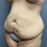 Tummy Tuck