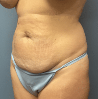 Tummy Tuck