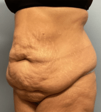 Tummy Tuck