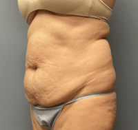 Tummy Tuck
