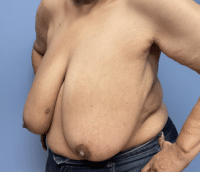 Breast Reduction
