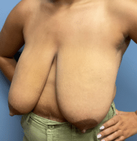 Breast Reduction