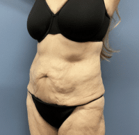 Circumferential Body Lift