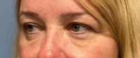 Eyelid Surgery