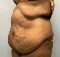 Panniculectomy