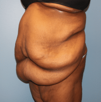 Panniculectomy