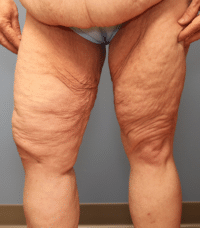 Thigh Lift