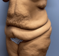 Tummy Tuck