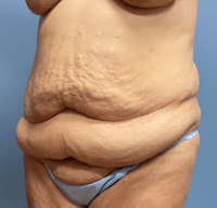 Tummy Tuck