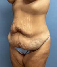 Tummy Tuck