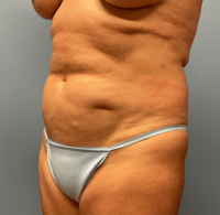 Tummy Tuck