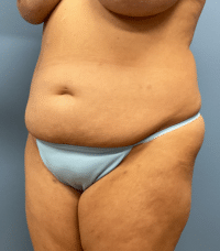 Tummy Tuck